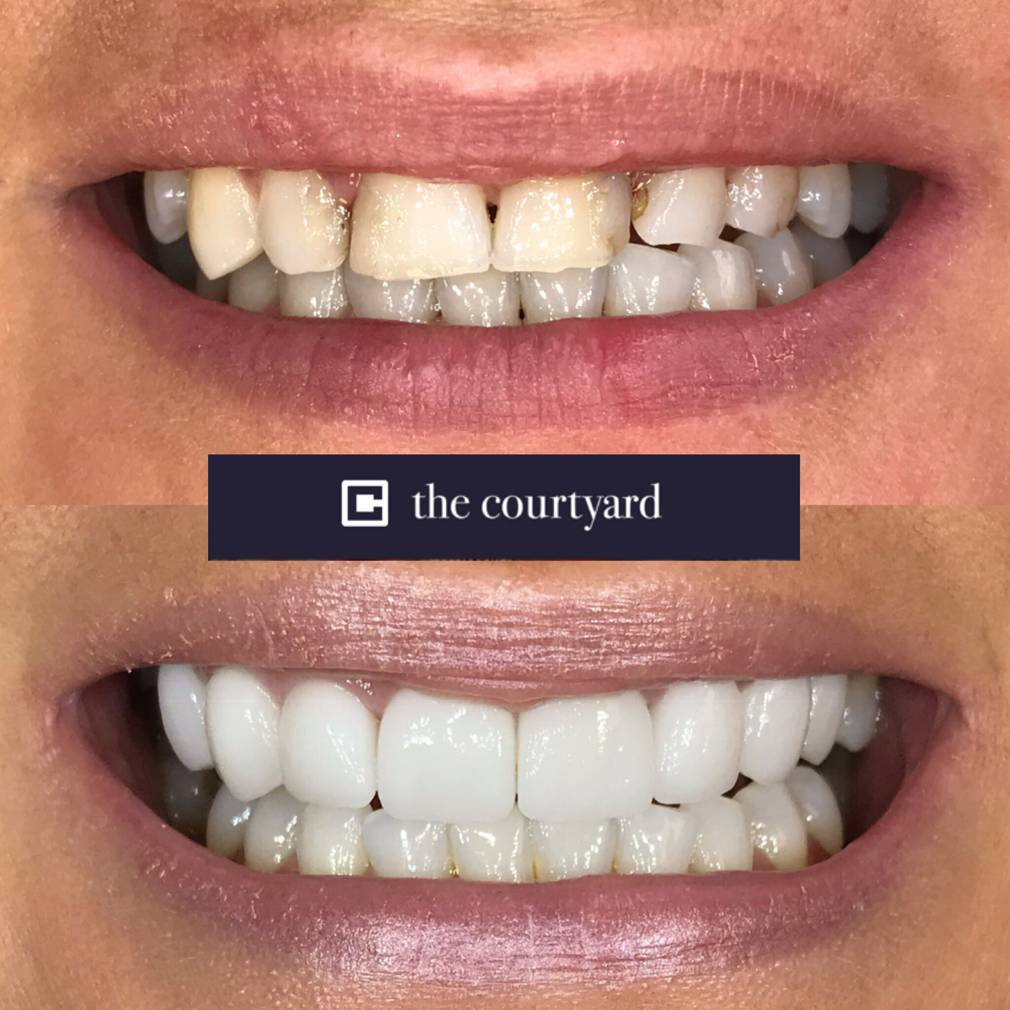 Porcelain Veneers Before And After 